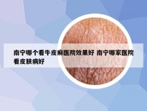 南宁哪个看牛皮癣医院效果好 南宁哪家医院看皮肤病好