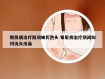 银屑病治疗期间如何洗头 银屑病治疗期间如何洗头洗澡