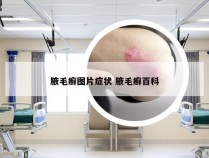 腋毛癣图片症状 腋毛癣百科