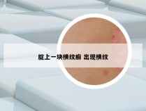 腚上一块横纹癣 出现横纹