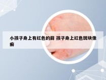 小孩子身上有红色的藓 孩子身上红色斑块像癣