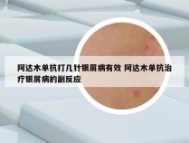 阿达木单抗打几针银屑病有效 阿达木单抗治疗银屑病的副反应