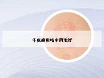 牛皮癣用啥中药泡好