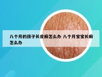 八个月的孩子长皮癣怎么办 八个月宝宝长癣怎么办