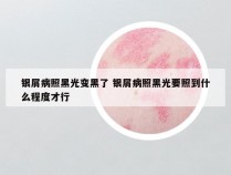 银屑病照黑光变黑了 银屑病照黑光要照到什么程度才行