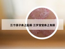 三个孩子身上起癣 三岁宝宝身上有藓