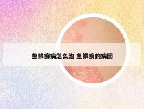 鱼鳞癣病怎么治 鱼鳞癣的病因