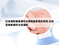 红皮病型银屑病可以使用激素类药膏吗 红皮型银屑病可以洗澡吗