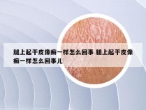 腿上起干皮像癣一样怎么回事 腿上起干皮像癣一样怎么回事儿