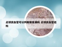 点球状血管可以判断银屑病吗 点球状血管结构