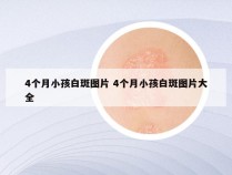 4个月小孩白斑图片 4个月小孩白斑图片大全