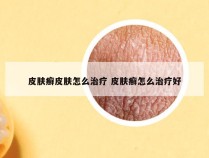 皮肤癣皮肤怎么治疗 皮肤癣怎么治疗好