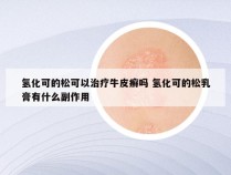 氢化可的松可以治疗牛皮癣吗 氢化可的松乳膏有什么副作用