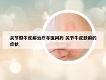 关节型牛皮癣治疗寻医问药 关节牛皮肤癣的症状