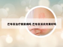 巴布膏治疗银屑病吗 巴布膏消炎效果好吗