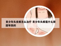 青少年头皮癣怎么治疗 青少年头癣是什么原因导致的