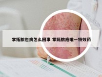 掌拓脓包病怎么回事 掌跖脓疱唯一特效药