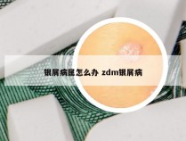 银屑病属怎么办 zdm银屑病