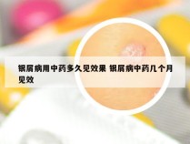 银屑病用中药多久见效果 银屑病中药几个月见效