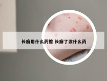 长癣用什么药擦 长癣了涂什么药