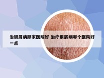 治银屑病那家医院好 治疗银屑病哪个医院好一点