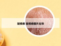 腿根癣 腿根癣图片名称