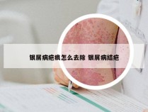 银屑病疤痕怎么去除 银屑病结疤