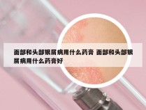 面部和头部银屑病用什么药膏 面部和头部银屑病用什么药膏好