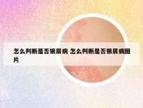 怎么判断是否银屑病 怎么判断是否银屑病图片