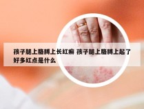 孩子腿上胳膊上长红癣 孩子腿上胳膊上起了好多红点是什么