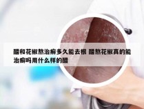 醋和花椒熬治癣多久能去根 醋熬花椒真的能治癣吗用什么样的醋