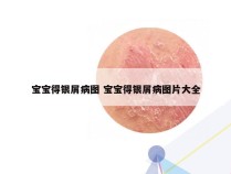 宝宝得银屑病图 宝宝得银屑病图片大全