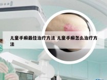 儿童手癣最佳治疗方法 儿童手癣怎么治疗方法