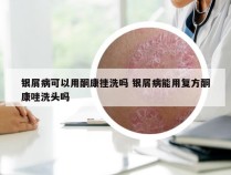 银屑病可以用酮康挫洗吗 银屑病能用复方酮康唑洗头吗