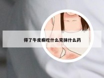 得了牛皮癣吃什么完抹什么药