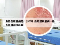 血热型银屑病是什么样子 血热型银屑病一般多长时间可以好