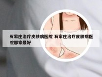 石家庄治疗皮肤病医院 石家庄治疗皮肤病医院那家最好