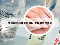 牛皮癣中药外洗管用吗 牛皮廨外洗中药