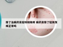 擦了治癣药膏后特别辣疼 癣药膏擦了轻微发痒正常吗