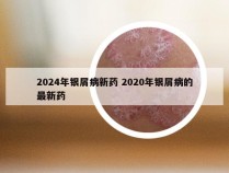 2024年银屑病新药 2020年银屑病的最新药