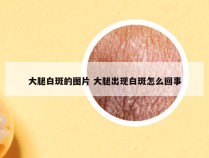 大腿白斑的图片 大腿出现白斑怎么回事