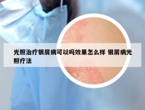 光照治疗银屑病可以吗效果怎么样 银屑病光照疗法