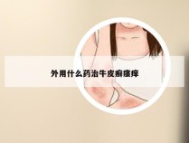 外用什么药治牛皮癣瘙痒