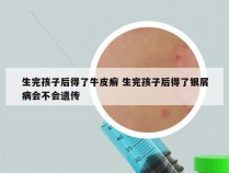 生完孩子后得了牛皮癣 生完孩子后得了银屑病会不会遗传