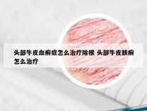 头部牛皮血癣症怎么治疗除根 头部牛皮肤癣怎么治疗