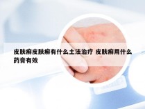 皮肤癣皮肤癣有什么土法治疗 皮肤癣用什么药膏有效