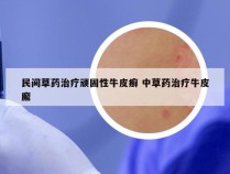 民间草药治疗顽固性牛皮癣 中草药治疗牛皮廨