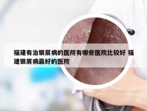 福建有治银屑病的医院有哪些医院比较好 福建银屑病最好的医院