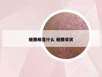 缠腰癣是什么 缠腰症状