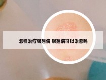 怎样治疗银翘病 银翘病可以治愈吗